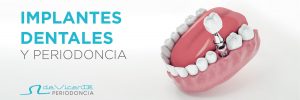 Implantes dentales y periodoncia