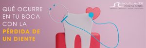 Qué ocurre en tu boca con la pérdida de un diente