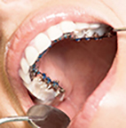 boca con tratamiento de ortodoncia en granada