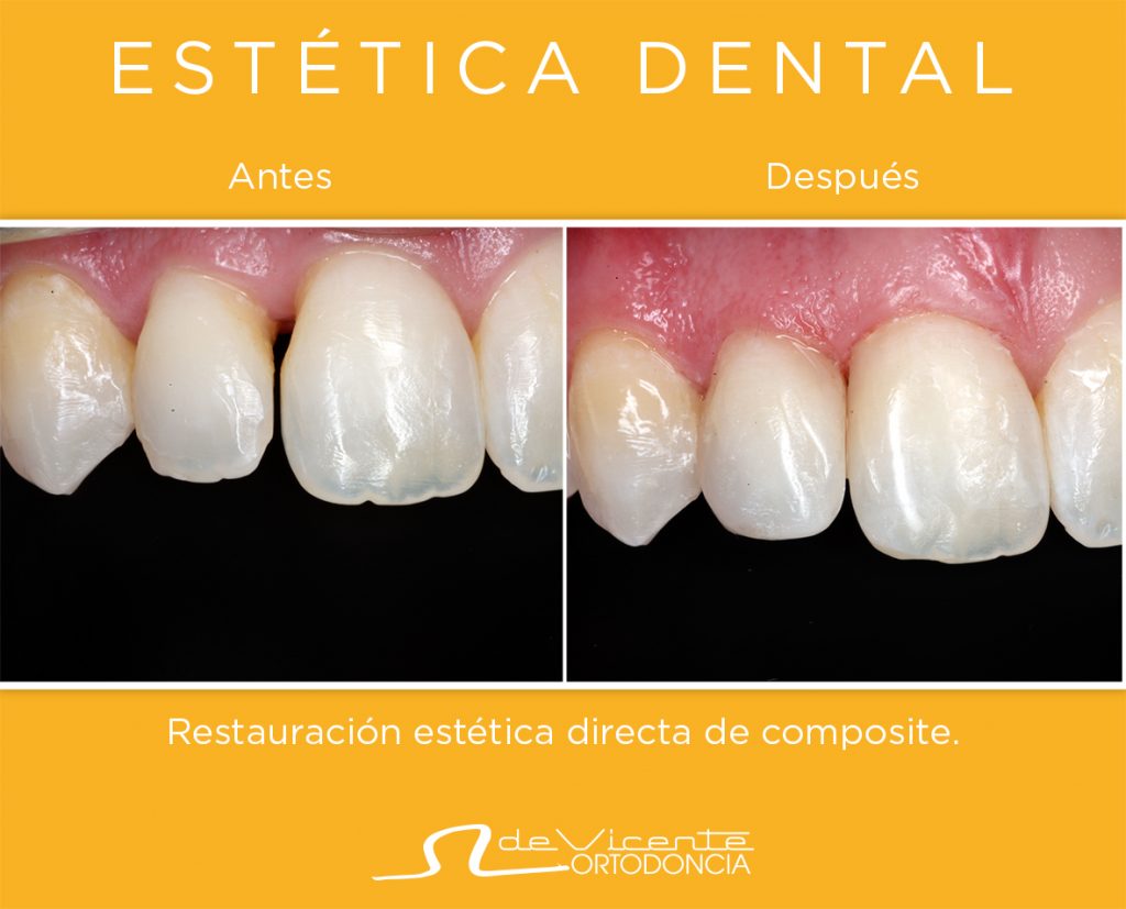 dentadura antes y después de un tratamiento de estética dental