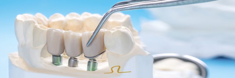 implante dental en clínica dental de vicente ortodoncia
