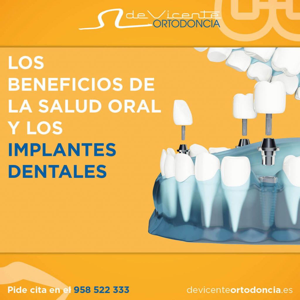 Los implantes dentales en la clinica dental De Vicente Ortodoncia en Granada