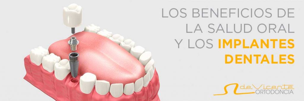 muestra de implante dental en Granada