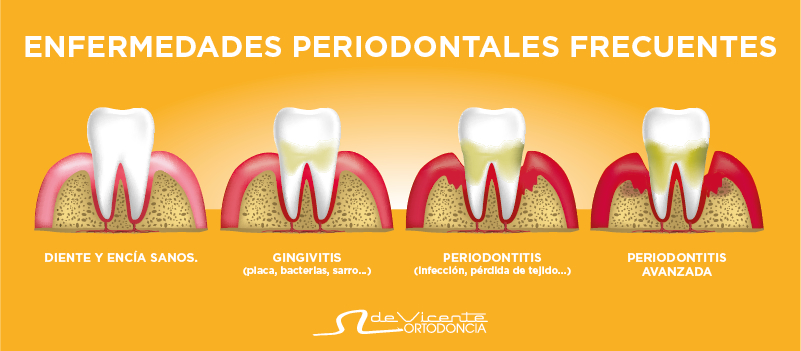 Infografía de las enfermedades de la periodoncia y su tratamiento en Granada