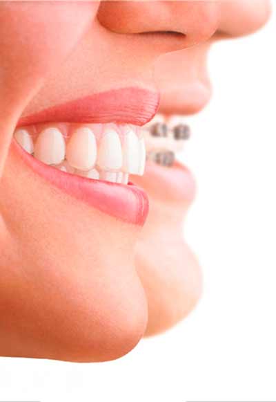 ortodoncia transparente invisalign en Granada y ortodoncia de brackets