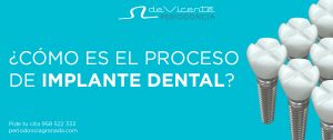 ¿Cómo es el proceso de implante dental?